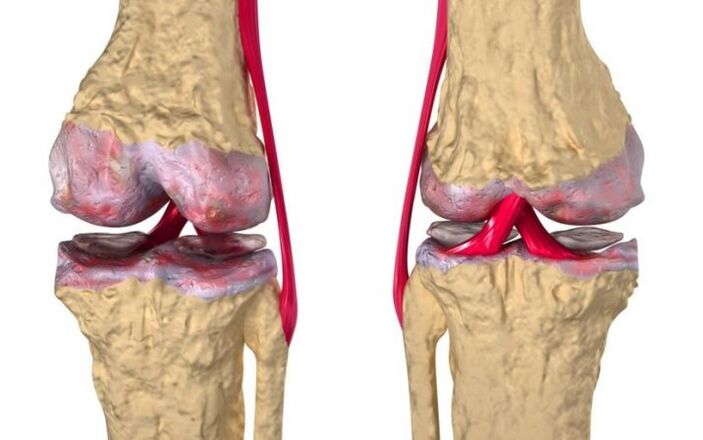 Osteoartrita articulației genunchiului